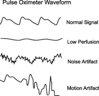 lines representing the different pulse oximeter waveforms
