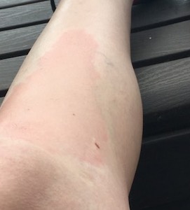 a larger splotch that appears like an allergic reaction to a bug bite