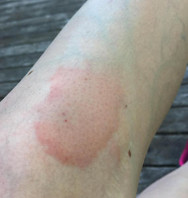 a red, splotchy circle on the skin that appears to be irritated