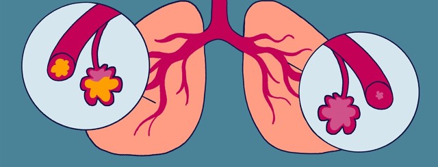 The Link Between Asthma and Pneumonia image
