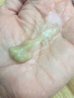 thick yellow mucus in the contributor's hand from a new angle