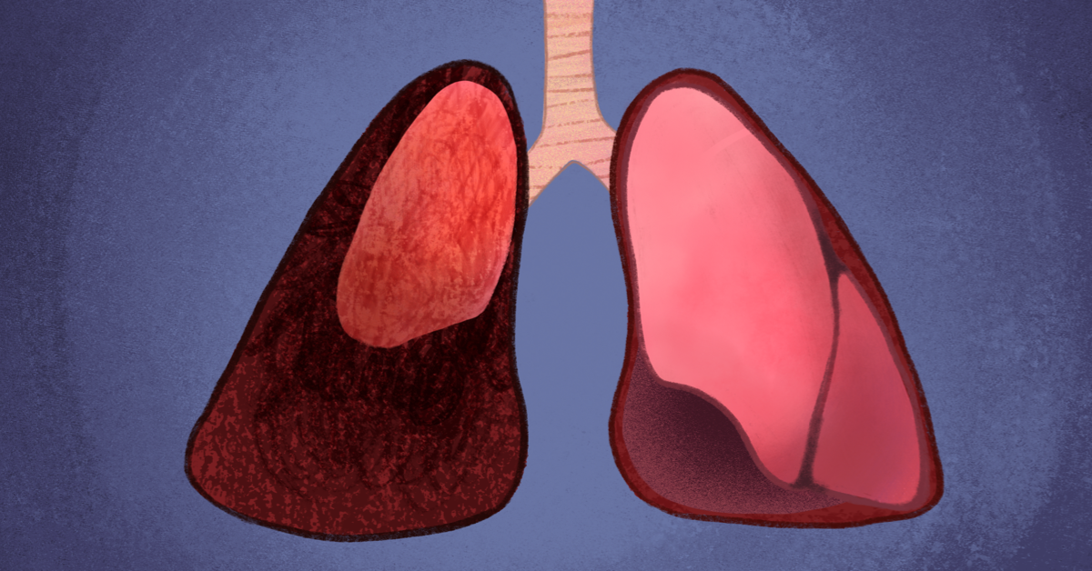 Experiencing a Partial Lung Collapse After Surgery with Asthma