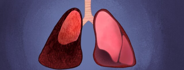 Partial Lung Collapse After Surgery image
